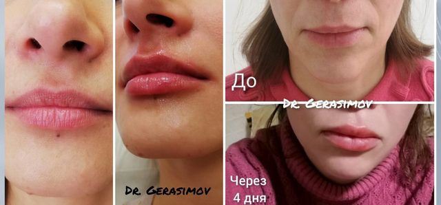 Губы, скулы, контурная пластика: работа врача, снимок 1 из 1